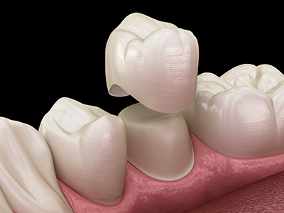 The image shows a close-up of a human dental implant with an abutment, placed in a mouth with visible teeth and gums.