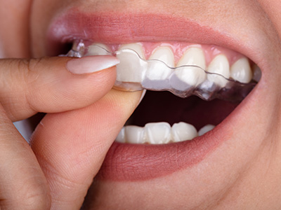 An image of a person holding a toothbrush with a mouthguard in place, showcasing dental hygiene practices.