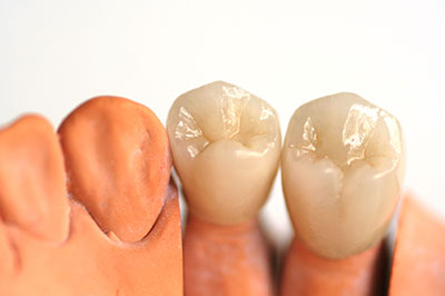 The image displays a set of dental implants with a natural tooth appearance, showcasing the artificial teeth and gumline.